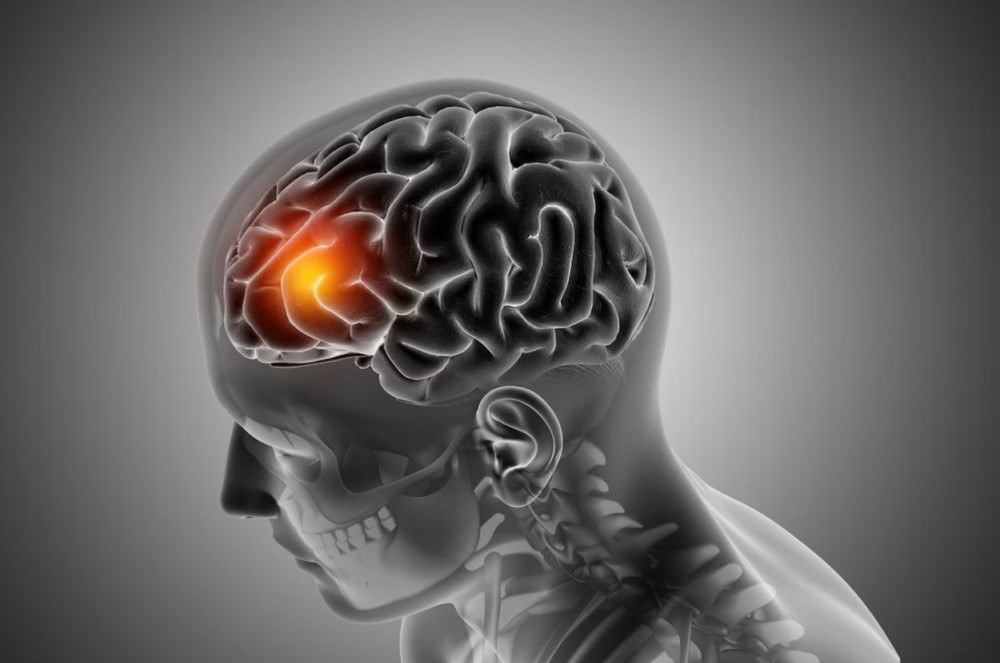 Brain Stroke Causes & Reasons